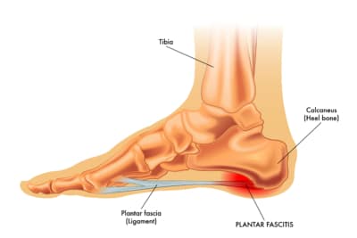 Plantar Fasciitis